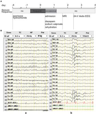 Bilateral tonic seizures probably induced by eperisone hydrochloride: a case report